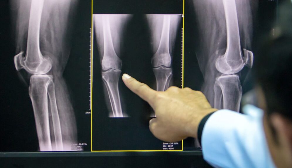 radiographie de l'arthrose du genou