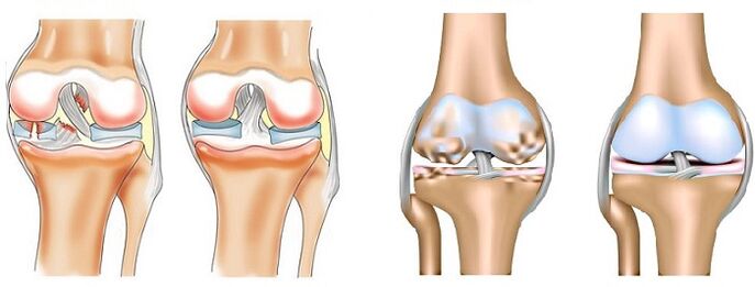 Différence entre l'arthrite (à gauche) et l'arthrose (à droite) des articulations