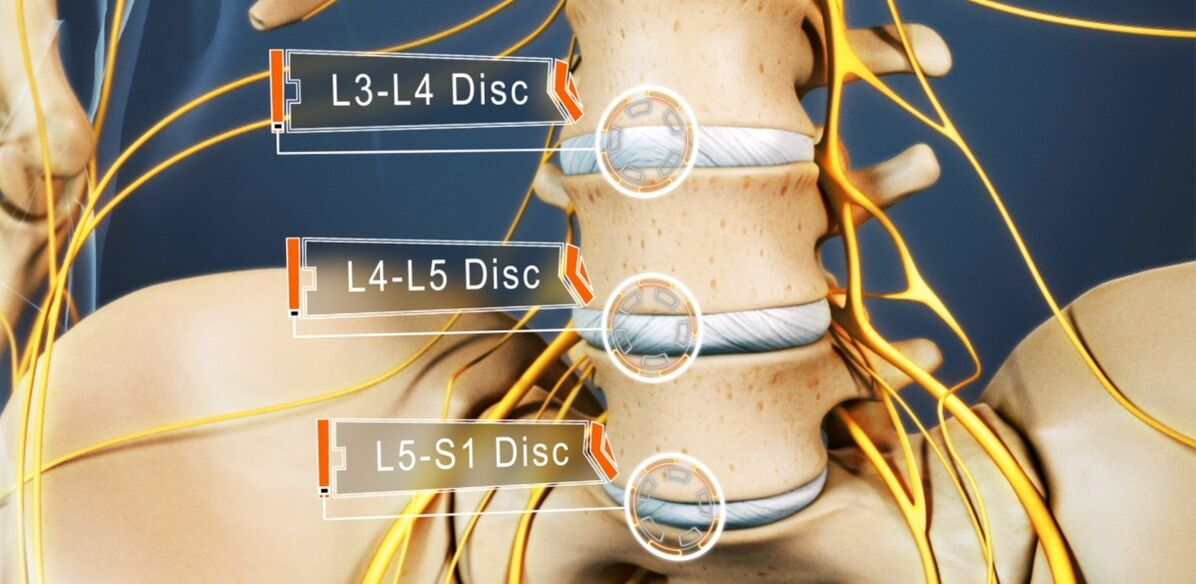 Disques de la colonne lombaire, qui sont le plus souvent touchés par l'ostéochondrose