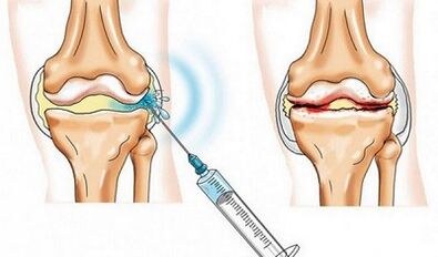 Le blocus de l'articulation du genou pour l'arthrose