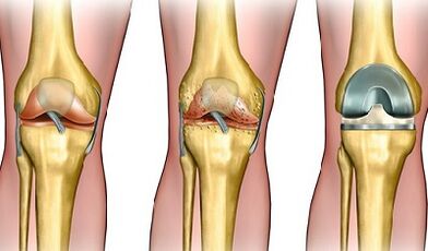 Le degré de développement de l'arthrose de l'articulation du genou