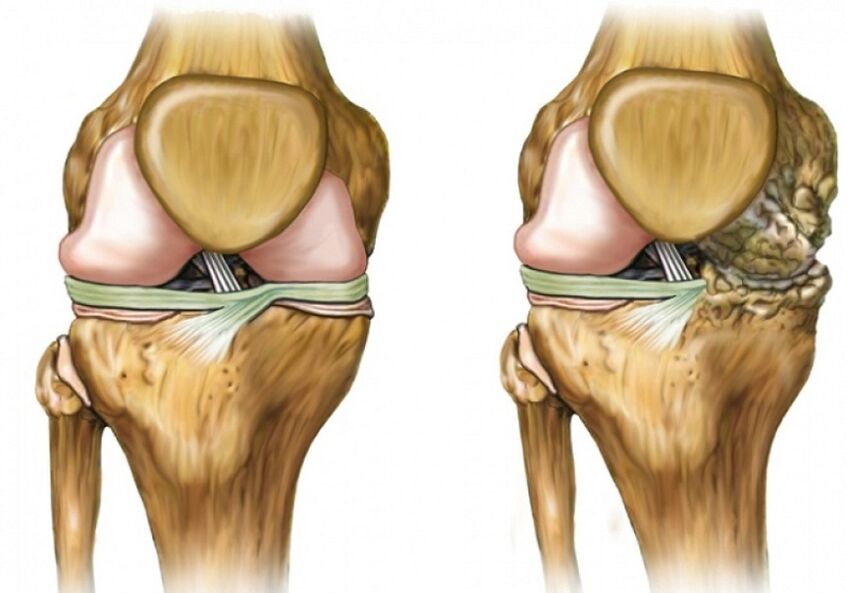 Arthrose du genou