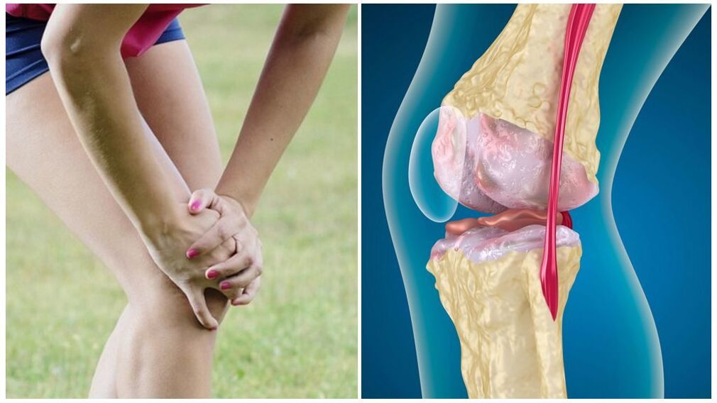 Symptômes d'arthrose
