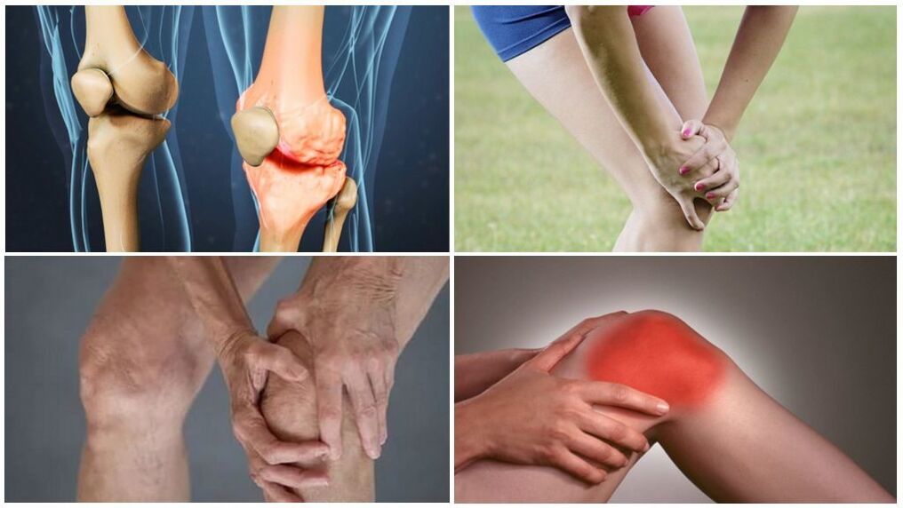 Étapes de l'arthrose