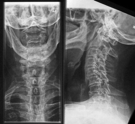 Cervical X -RAY - Méthode de diagnostic d'ostéochondrose