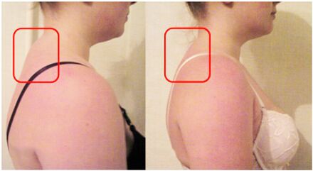 Formation de rouleau musculaire avec ostéochondrose cervicale
