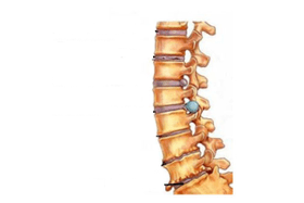 Dommage à la colonne vertébrale avec une ostéochondose cervicale