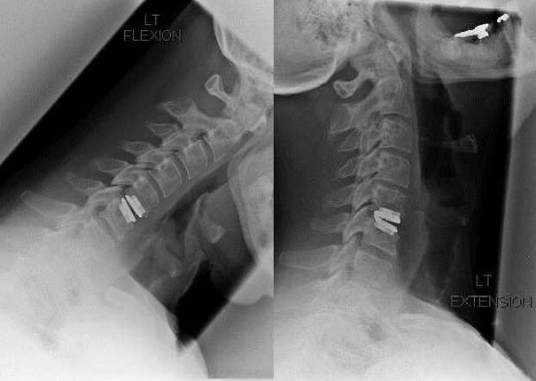 image de la colonne vertébrale après la chirurgie