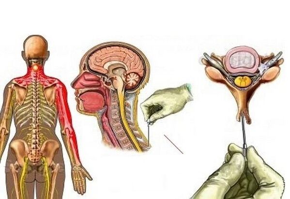 traitement de l'ostéochondrose cervicale par acupuncture
