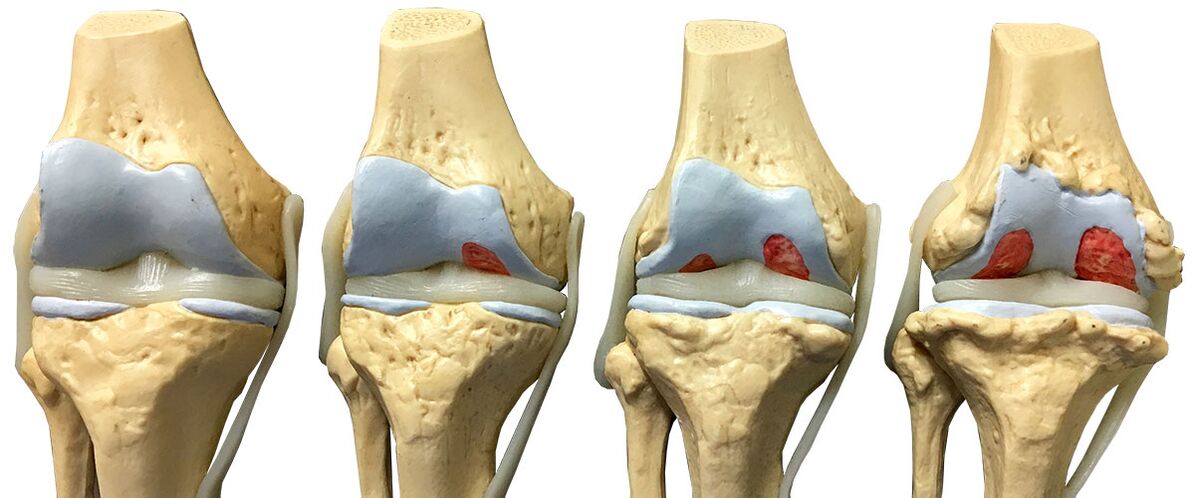 stades de l'arthrose