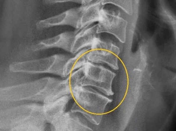 Ostéochondrose de la colonne cervicale à la radiographie